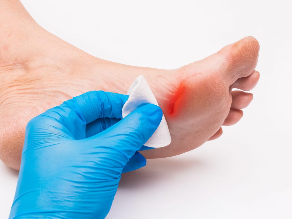 diabetes mellitus